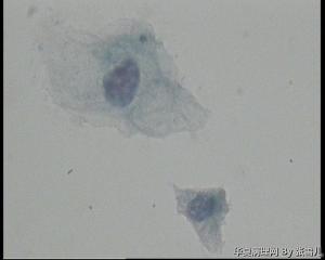 28岁TCT，ASC—US吗？图6