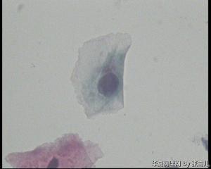 28岁TCT，ASC—US吗？图12