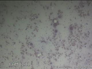 甲状腺细针穿刺涂片图18