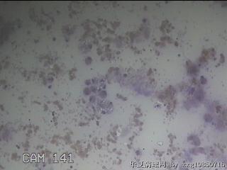 甲状腺细针穿刺涂片图17