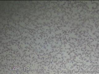 甲状腺细针穿刺涂片图12