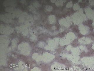 甲状腺细针穿刺涂片图7