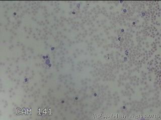右侧甲状腺下极肿物细针穿刺涂片图19