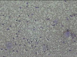 右侧甲状腺上极肿物细针穿刺涂片图25