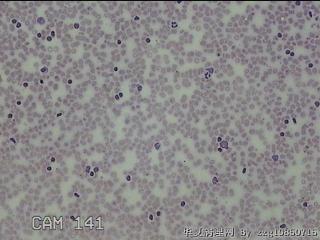 右侧甲状腺下极肿物细针穿刺涂片图18