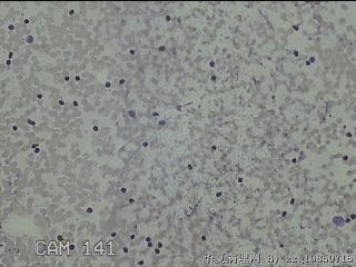 右侧甲状腺下极肿物细针穿刺涂片图30