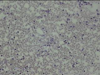 右侧甲状腺上极肿物细针穿刺涂片图32
