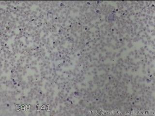 右侧甲状腺上极肿物细针穿刺涂片图17