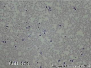 右侧甲状腺下极肿物细针穿刺涂片图21