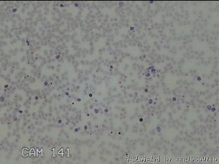 右侧甲状腺上极肿物细针穿刺涂片图6