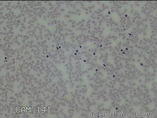 右侧甲状腺上极肿物细针穿刺涂片图9