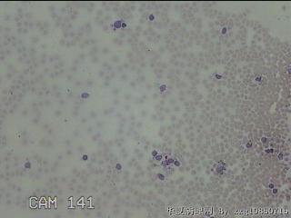 右侧甲状腺下极肿物细针穿刺涂片图20