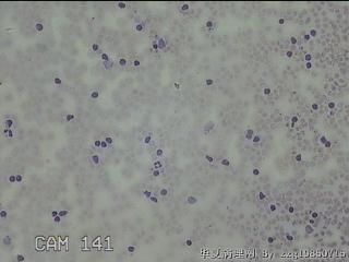右侧甲状腺下极肿物细针穿刺涂片图16