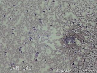 右侧甲状腺上极肿物细针穿刺涂片图3