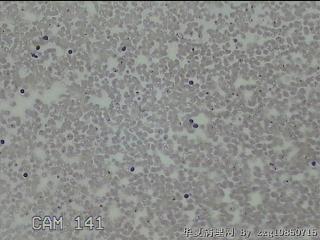 右侧甲状腺下极肿物细针穿刺涂片图14