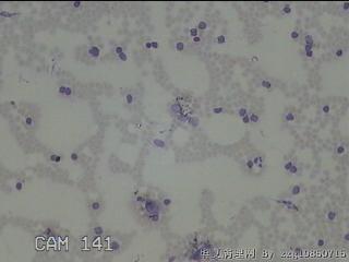 右侧甲状腺下极肿物细针穿刺涂片图27