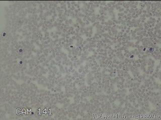 右侧甲状腺下极肿物细针穿刺涂片图4