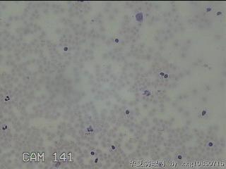 右侧甲状腺上极肿物细针穿刺涂片图4