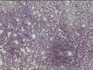 右侧甲状腺上极肿物细针穿刺涂片图1