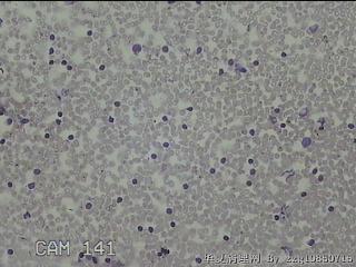 右侧甲状腺上极肿物细针穿刺涂片图11