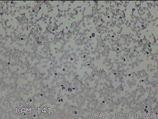 右侧甲状腺上极肿物细针穿刺涂片图23
