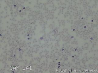 右侧甲状腺上极肿物细针穿刺涂片图16