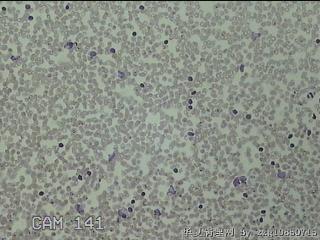 右侧甲状腺上极肿物细针穿刺涂片图7