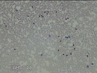 右侧甲状腺上极肿物细针穿刺涂片图19