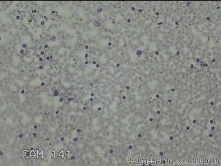 右侧甲状腺下极肿物细针穿刺涂片图24