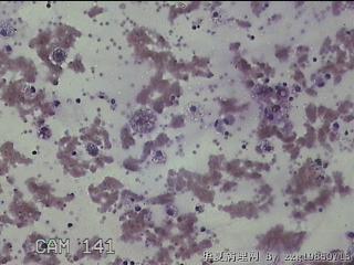 甲状腺结节细针穿刺涂片图19