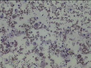 甲状腺结节细针穿刺涂片图16