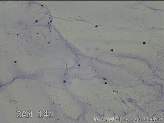 膝关节腔积液11ml图29