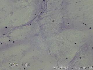 膝关节腔积液11ml图22