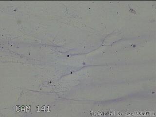 膝关节腔积液11ml图30
