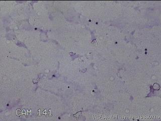 膝关节腔积液11ml图6