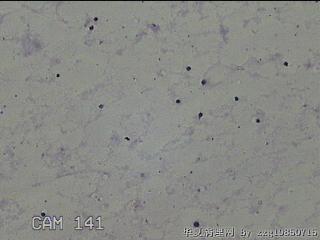 膝关节腔积液11ml图26