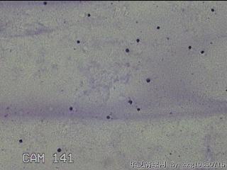 膝关节腔积液11ml图21