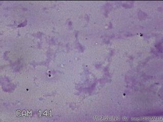 膝关节腔积液11ml图4