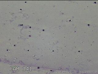 膝关节腔积液11ml图23
