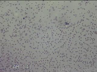 左侧甲状腺细针穿刺涂片图20
