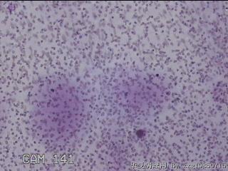 左侧甲状腺细针穿刺涂片图32