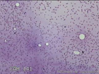 左侧甲状腺细针穿刺涂片图22
