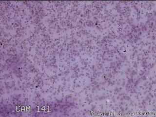左侧甲状腺细针穿刺涂片图7