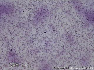 左侧甲状腺细针穿刺涂片图11