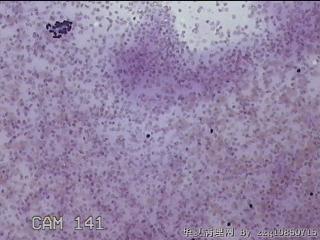 左侧甲状腺细针穿刺涂片图8