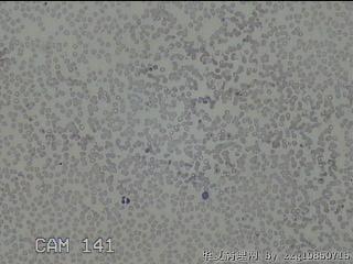 右侧甲状腺细针穿刺涂片图8