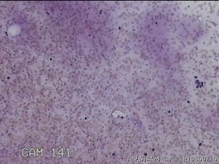 左侧甲状腺细针穿刺涂片图14
