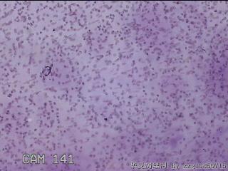 左侧甲状腺细针穿刺涂片图23