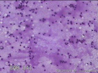 膝关节腔积液12ml图21