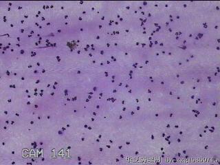 膝关节腔积液12ml图17